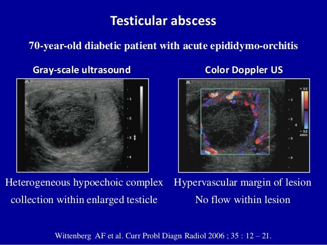 varicocele ultrasound images