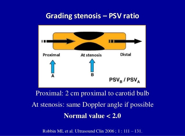 Doppler ultrasound of carotid arteries
