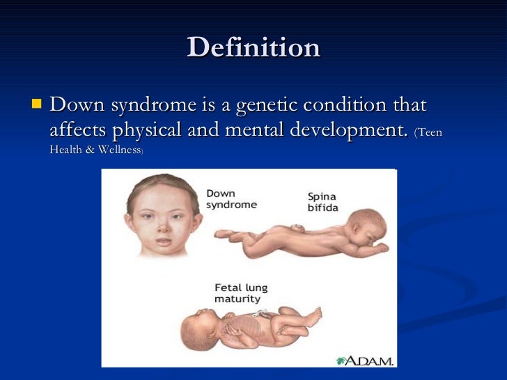 the description of the causes symptoms and treatment of downs syndrome Description down syndrome is a chromosomal condition that is associated with intellectual disability which causes down syndrome. the description of the causes symptoms and treatment of downs syndrome Description down syndrome is a chromosomal condition that is associated with intellectual disability which causes down syndrome.