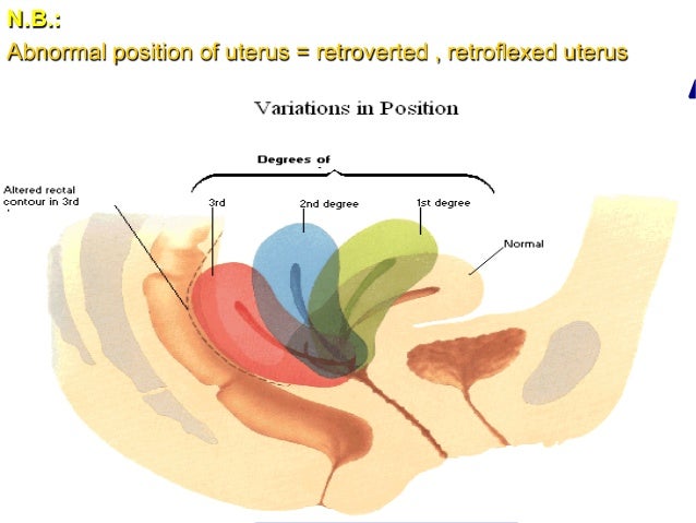 Anteverted Uterus