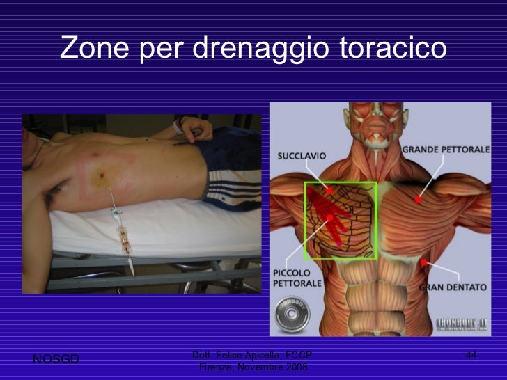 Drenaggio A Caduta O In Aspirazione Il drenaggio toracico