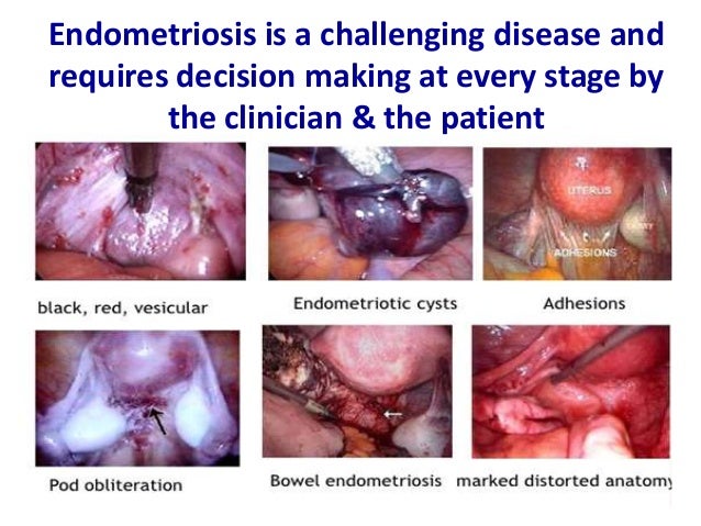Endometriosis stage 4