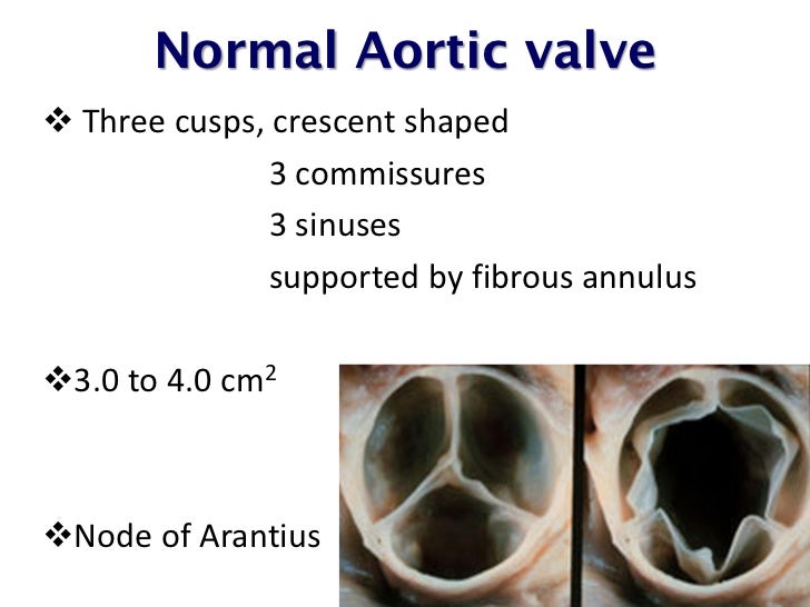 Echo assessment of Aortic Stenosis