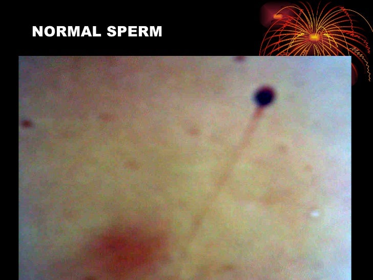 olsen twins nude breasts slight abnormality in sperm