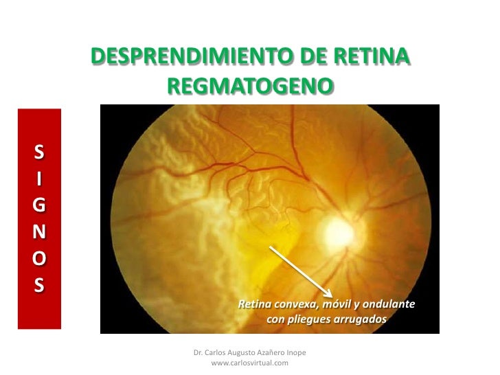 DESPRENDIMIENTO DE RETINA REGMATOGENO DESPRENDIMIENTO DE RETINA REGMATOGENO