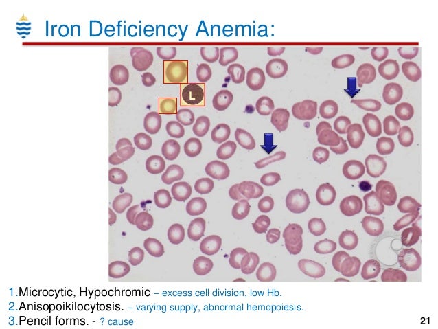 Causes of microcytic anemia in adults