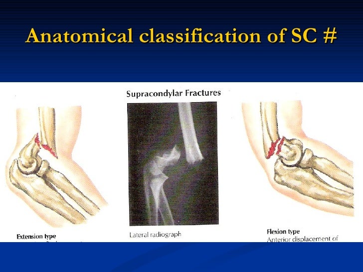 icd 10 code for supracondylar fracture