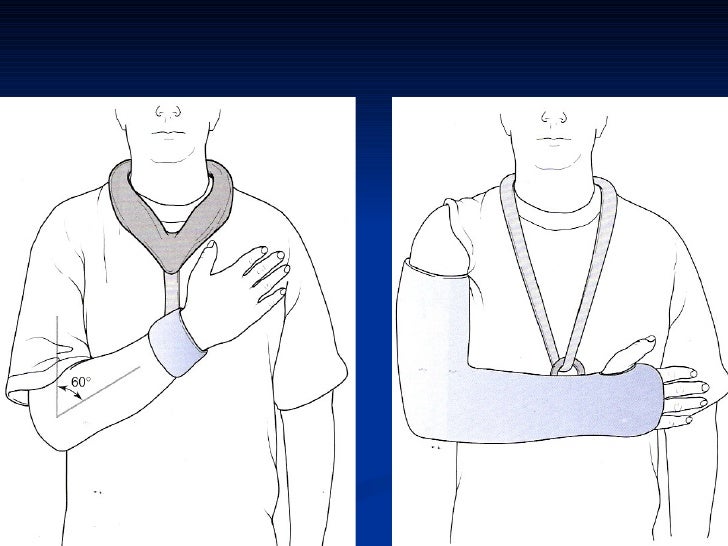 D) supracondylar fracture