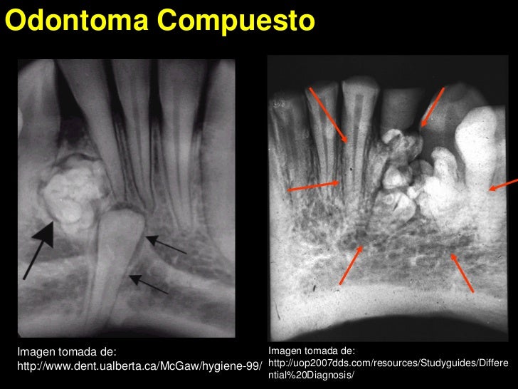 Odontoma