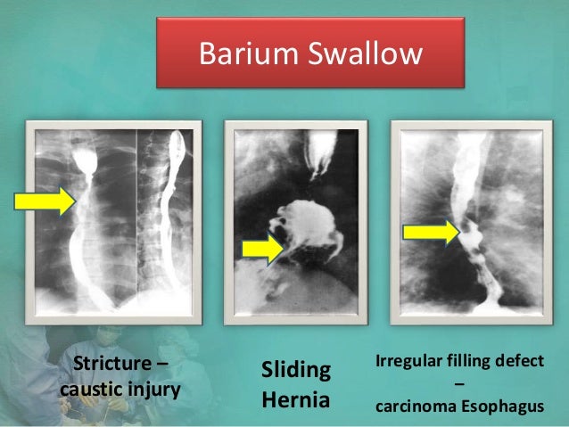 Esophageal Stricture Barium Swallow Gastroesophageal Reflux Disease