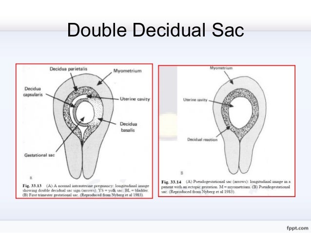 Double Ring Sign Ectopic Pregnancy Double Ring Sign Ectopic Pregnancy