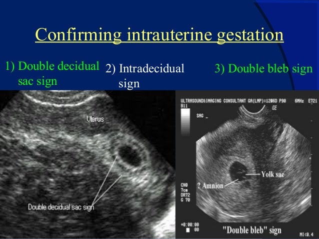 ultrasound dating during pregnancy