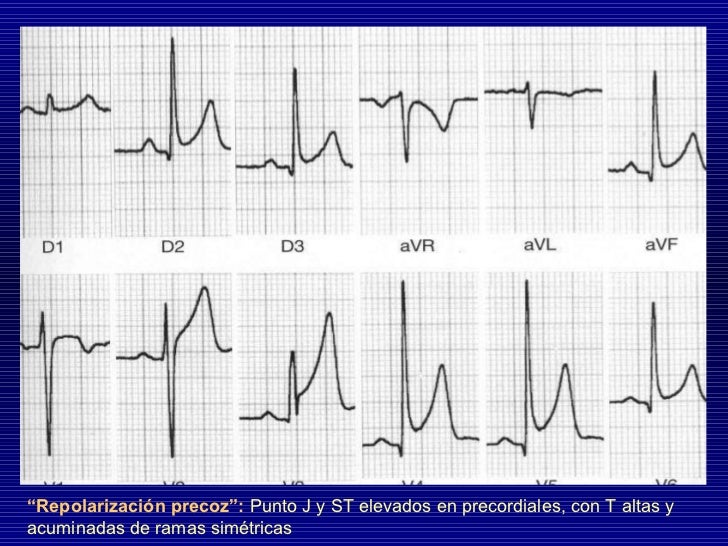 Electrocardiograma