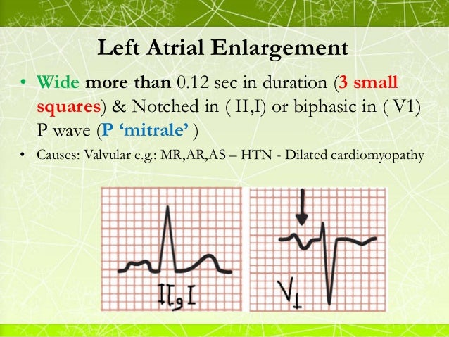Notched P Wave On Ecg