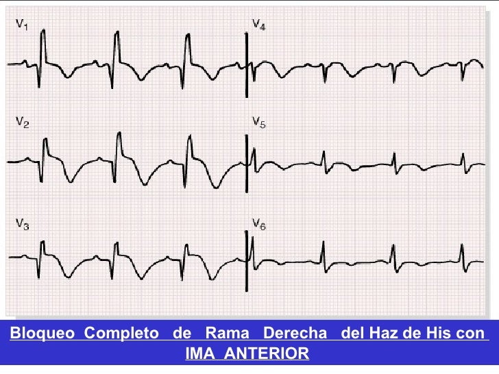 Ecg Ii Isquemia Ecg Ii Isquemia