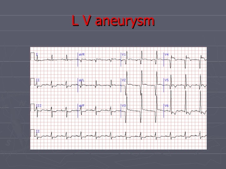 lv apical aneurysm ecg Ecg in AMI