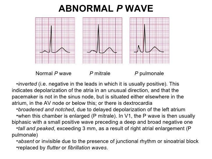 Ecg Lecture