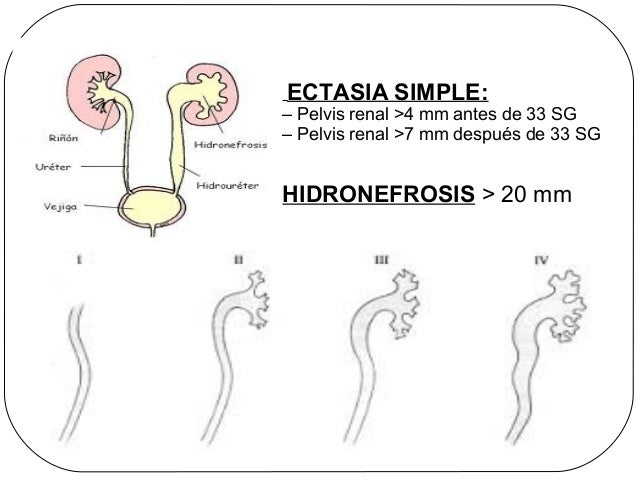 Ectasiapielica jc
