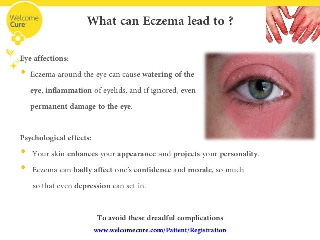What causes eye eczema? - Skin Magazine
