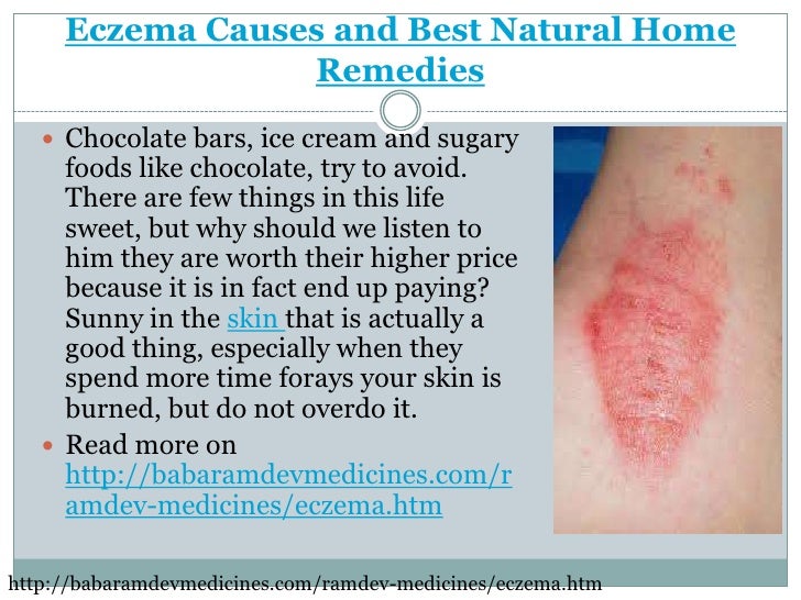 Natural Home Remedies For Eczema Natural Home Remedies For Eczema