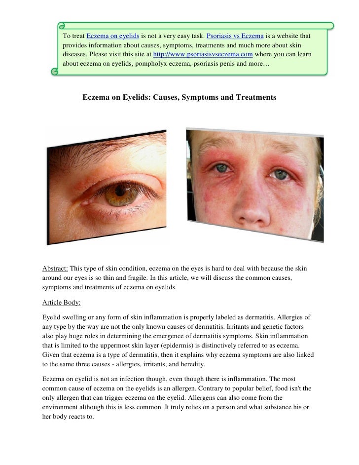 eyelid dermatitis treatments