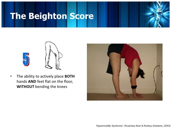 EhlersDanlos Syndrome & Hypermobility