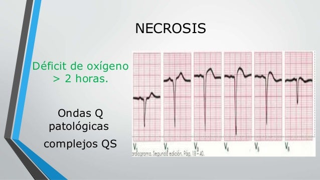 Ekg Patologico Ekg Patologico