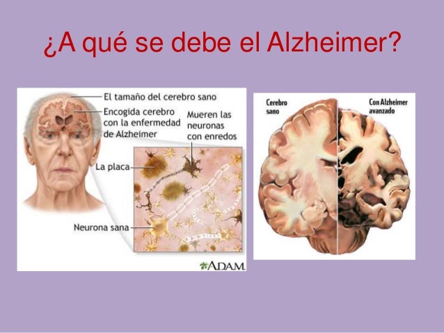 Resultado de imagen de el alzheimer