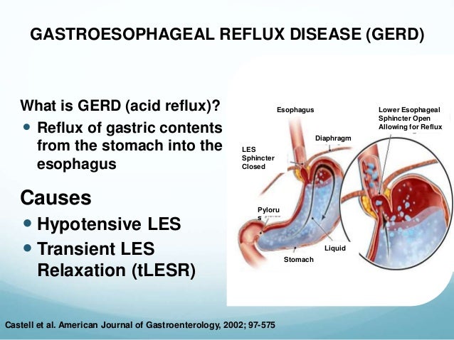 A Natural Heartburn Cure By Strengthening the LES