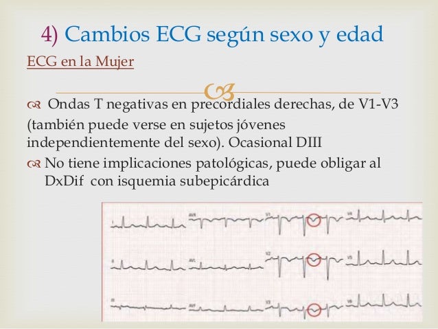 intervalo pr electrocardiograma