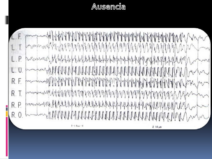 Electroencefalograma (eeg) en epilepsia Electroencefalograma (eeg) en epilepsia