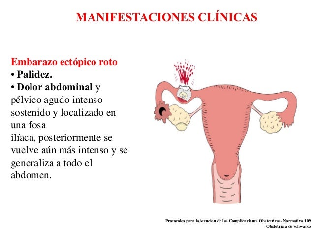 Embarazo ectopico