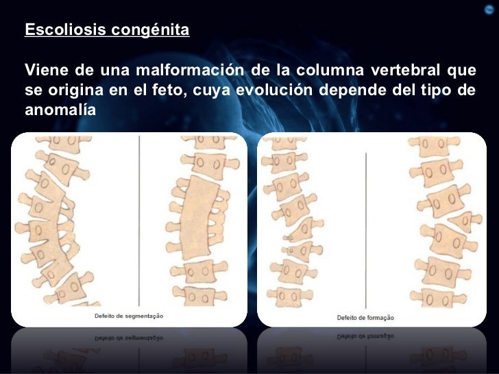 Como comprender que bolyat los músculos de la espalda