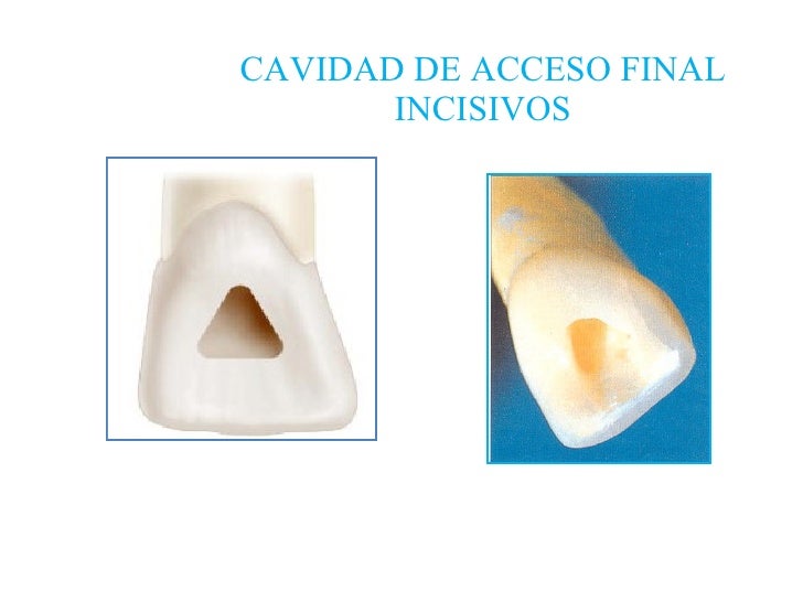 Endodoncia