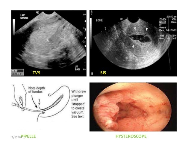 Endometrial Hyperplasia endometrial-hyperplasia