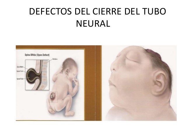DEFECTOS DEL CIERRE DEL TUBO NEURAL