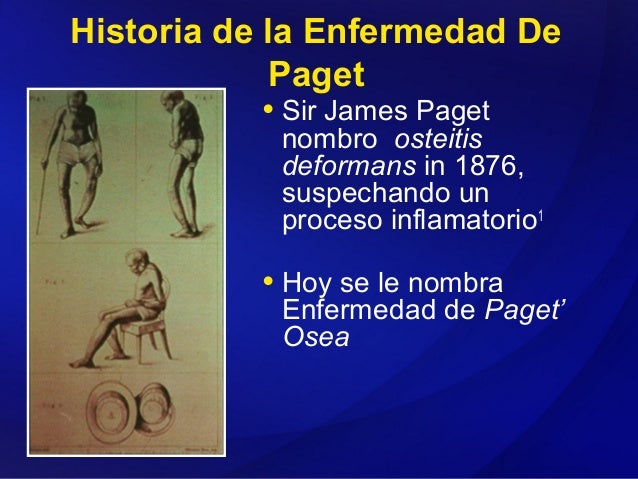 La enfermedad de paget fotos La enfermedad de paget fotos