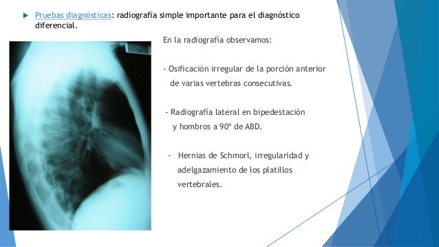 La cultura física medicinal a la osteocondrosis sheyno del departamento de pecho