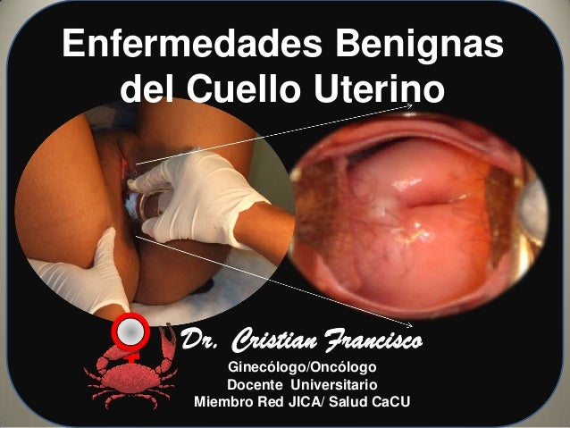 LESIONES EN EL CUELLO UTERINO lesiones en el cuello uterino: