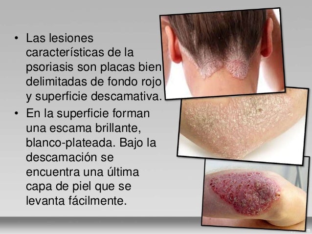 Los ungüentos de la psoriasis con el zinc