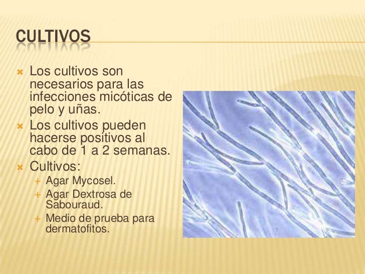 Como curar las uñas encarnadas en el pie