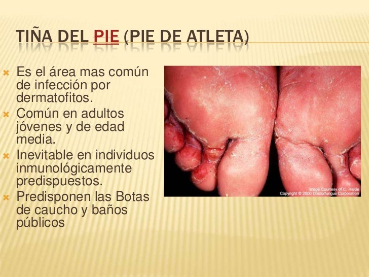 Una fuerte medicina contra el hongo de las uñas