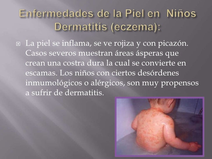 Piel de niños