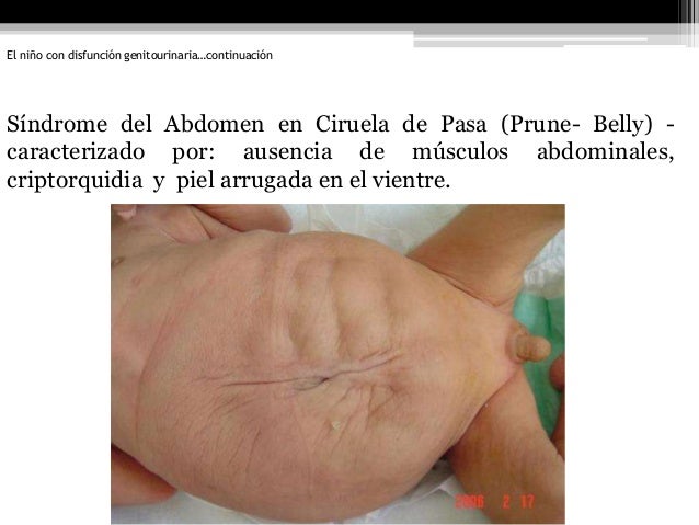 Como curar kistu en sheynom el departamento de la columna vertebral