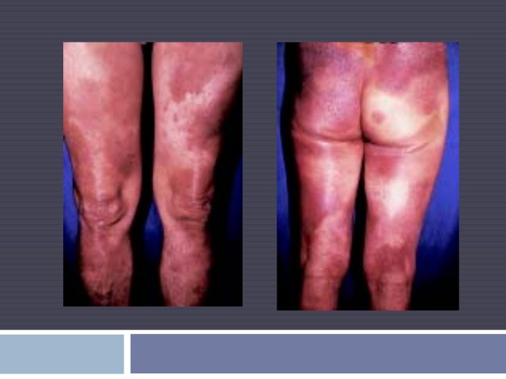La arcilla del mar muerto de la psoriasis