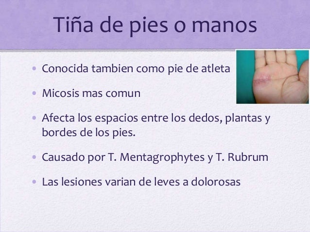 Que tal el hongo de los pie y como de determinarle