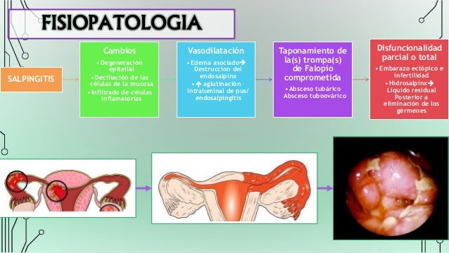 Fisiopatologia De La Enfermedad Inflamatoria Pelvica
