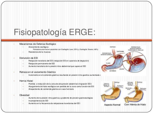 Enfermedad por reflujo gastroesofagico ERGE