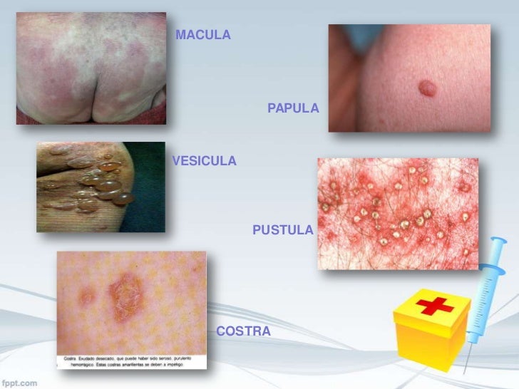 Enfermedades exantemicas