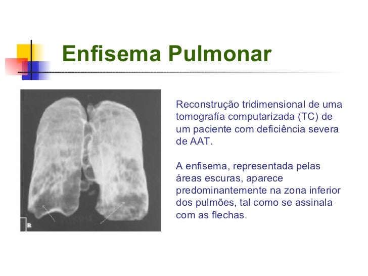 enfisema-pulmonar-3-728.jpg?cb=1237548709